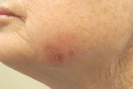 Erythematous Scaly Patch On The Jawline Mdedge Dermatology